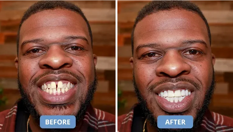 Shiny Smile Veneers 13